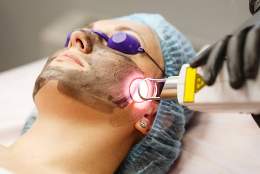 Laser carbon peel procedure.