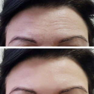 Botox 2 Botox 2