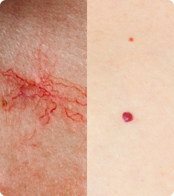 Cherry & Spider Angioma Removal | Markham’s Premier Clinic