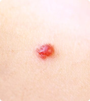 Cherry & Spider Angioma Removal