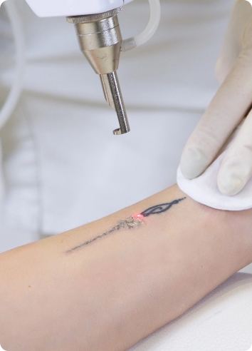 What You Need to Know About Tattoo Infections