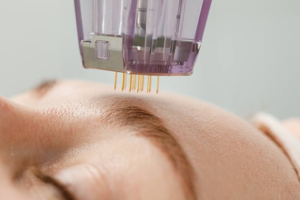 Micro-needling is One of the Best Skin Rejuvenation Treatments