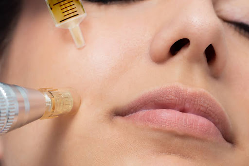 Micro-needling process on the face.